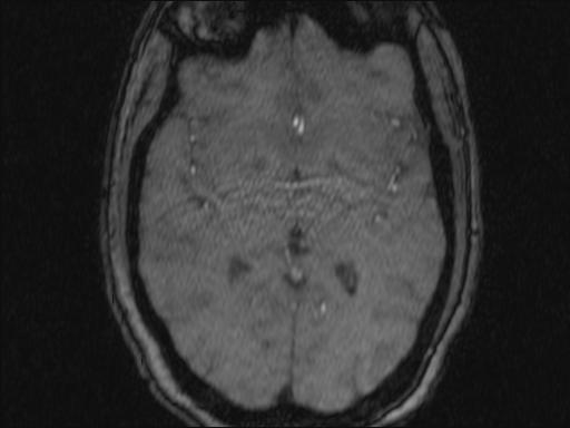 Bilateral carotid body tumors and right glomus jugulare tumor (Radiopaedia 20024-20060 Axial MRA 349).jpg