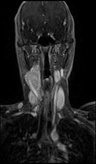 Bilateral carotid body tumors and right glomus jugulare tumor (Radiopaedia 20024-20060 MRA 23).jpg