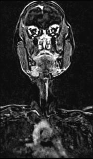 Bilateral carotid body tumors and right glomus jugulare tumor (Radiopaedia 20024-20060 MRA 77).jpg