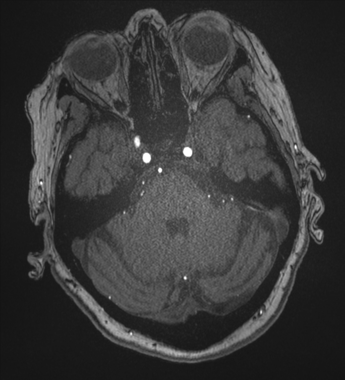 Bilateral fetal posterior communicating arteries (Radiopaedia 41286-44102 Axial MRA 52).png