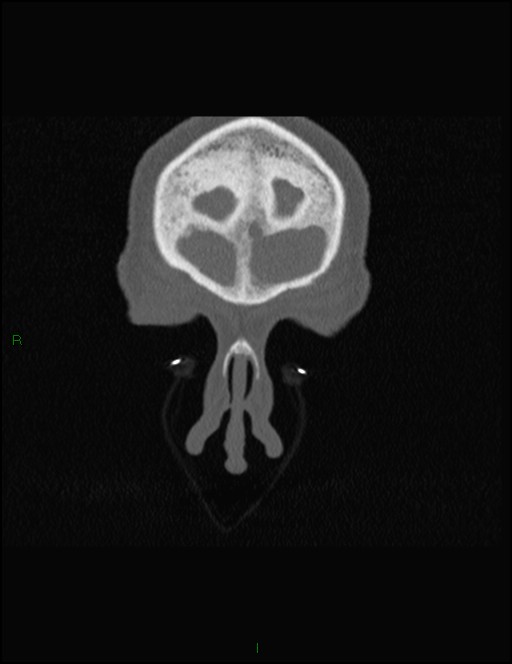 Bilateral frontal mucoceles (Radiopaedia 82352-96454 Coronal 41).jpg