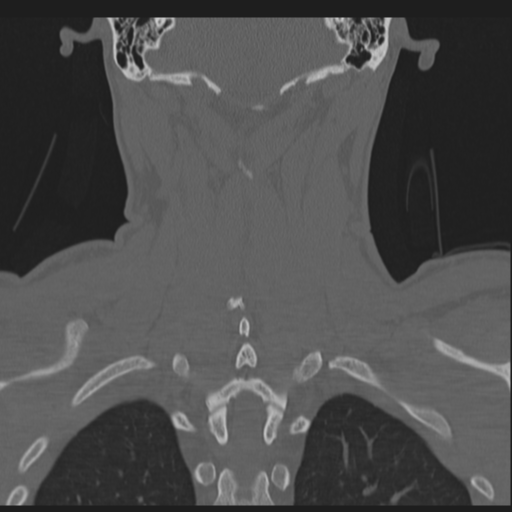 Bilateral locked facets (Radiopaedia 33850-35016 Coronal bone window 66).png