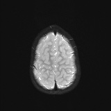 File:Bilateral mesial temporal polymicrogyria (Radiopaedia 76456-88181 Axial DWI 22).jpg