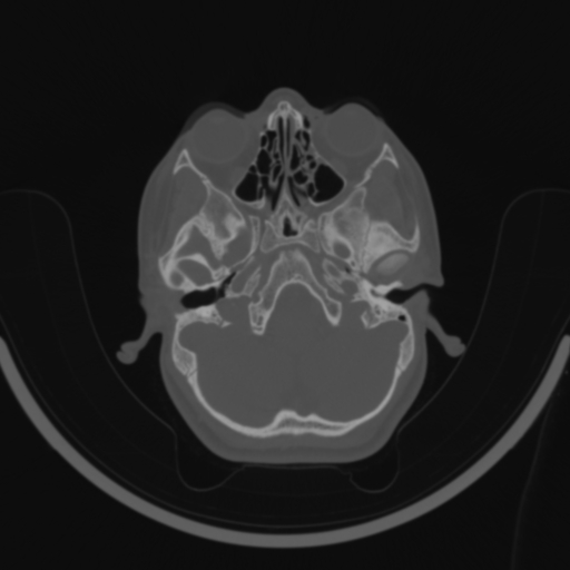 Bilateral otosclerosis (Radiopaedia 57237-64157 C 31).jpg