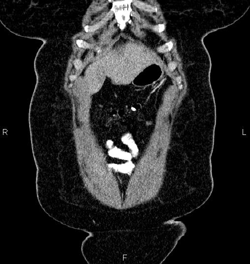 Bilateral ovarian dermoid cysts (Radiopaedia 85785-101603 C 1).jpg