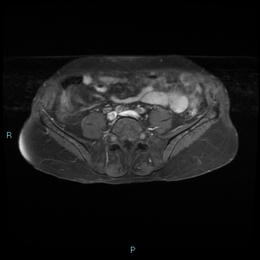 File:Bilateral ovarian fibroma (Radiopaedia 44568-48293 Axial T1 C+ fat sat 1).jpg