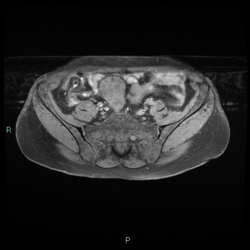 File:Bilateral ovarian fibroma (Radiopaedia 44568-48293 Axial T1 fat sat 5).jpg