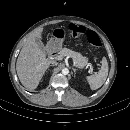 Bilateral pulmonary AVM (Radiopaedia 83134-97505 A 77).jpg