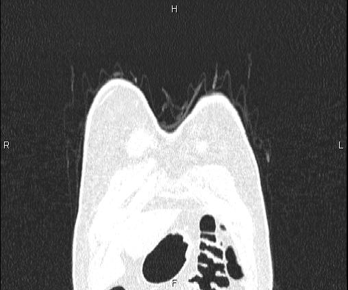 File:Bilateral pulmonary AVM (Radiopaedia 83134-97505 Coronal lung window 10).jpg