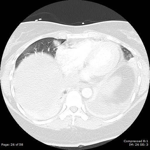 Bilateral pulmonary emboli with Hampton hump sign (Radiopaedia 54070-60246 Axial lung window 26).jpg