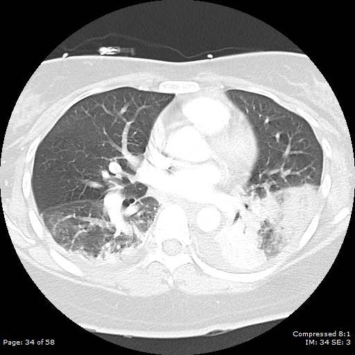 Bilateral pulmonary emboli with Hampton hump sign (Radiopaedia 54070-60246 Axial lung window 34).jpg