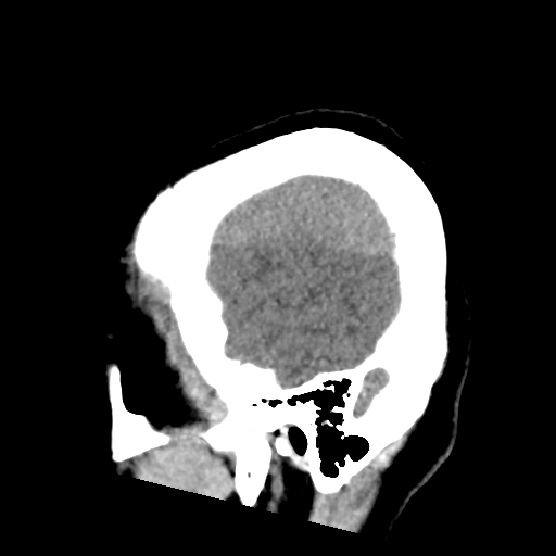 File:Bilateral subacute subdural hematoma (Radiopaedia 69240-79018 C 6).jpg
