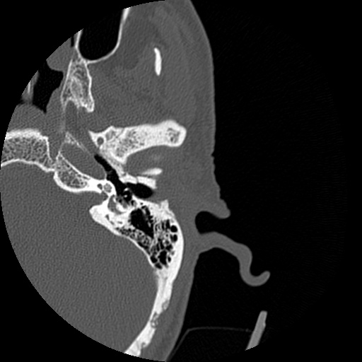 Bilateral temporal bone fractures (Radiopaedia 29482-29970 D 71).jpg