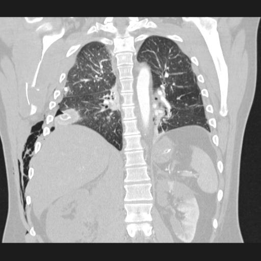 Bilateral traumatic renovascular injury (Radiopaedia 32051-32995 Coronal lung window 54).jpg
