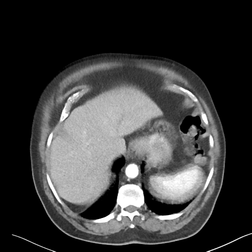 File:Bladder papillary urothelial carcinoma (Radiopaedia 48119-52951 A 3).png