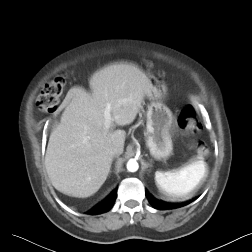 File:Bladder papillary urothelial carcinoma (Radiopaedia 48119-52951 A 8).png