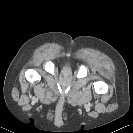 File:Bladder papillary urothelial carcinoma (Radiopaedia 48119-52951 Axial C+ delayed 65).png