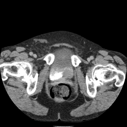Bladder tumor detected on trauma CT (Radiopaedia 51809-57609 C 138).jpg