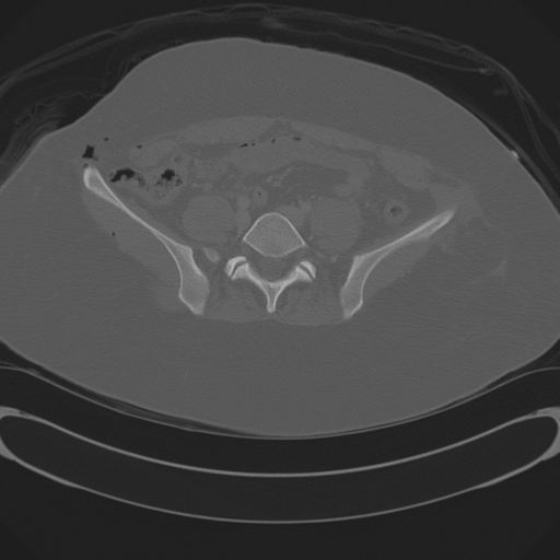 Blood in uterovesical and rectovesical pouch in trauma patient (Radiopaedia 34090-35340 Axial bone window 50).png