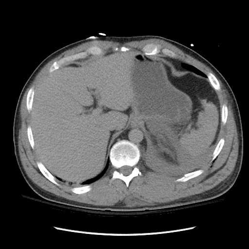 Blunt abdominal trauma with solid organ and musculoskelatal injury with active extravasation (Radiopaedia 68364-77895 Axial C+ delayed 28).jpg