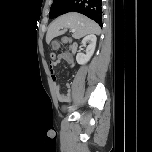 File:Blunt abdominal trauma with solid organ and musculoskelatal injury with active extravasation (Radiopaedia 68364-77895 C 56).jpg