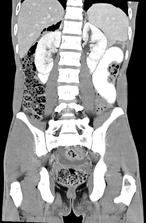 Blunt injury to the small bowel (Radiopaedia 74953-85987 B 66).jpg
