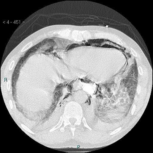 Boerhaave syndrome (Radiopaedia 27683-27897 lung window 83).jpg