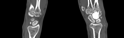 Bone islands - carpus (Radiopaedia 63141-71658 Coronal bone window 29).jpg