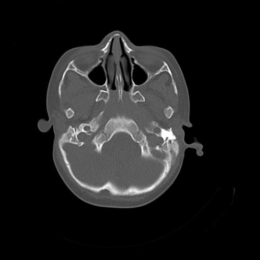 File:Bony atresia of the right external auditory canal (Radiopaedia 27916-28156 Axial bone window 2).jpg