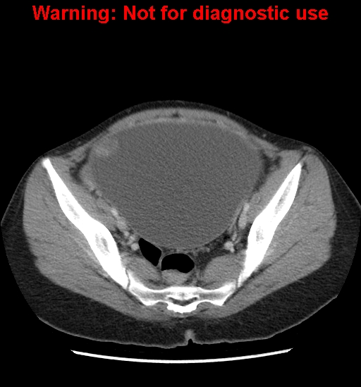 Borderline mucinous cystadenoma of ovary (Radiopaedia 25586-25767 A 89).jpg