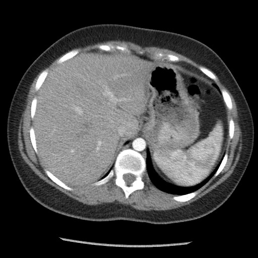 File:Borderline mucinous tumor (ovary) (Radiopaedia 78228-90808 A 41).jpg