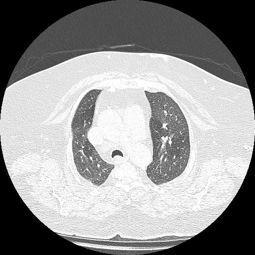 Bovine aortic arch - right internal mammary vein drains into the superior vena cava (Radiopaedia 63296-71875 Axial lung window 44).jpg