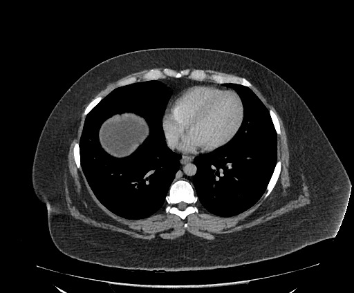 Bowel and splenic infarcts in acute lymphocytic leukemia (Radiopaedia 61055-68913 A 11).jpg