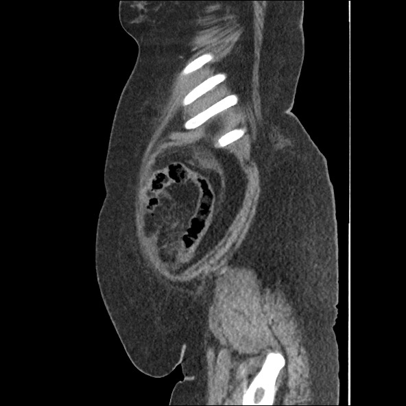 Bowel and splenic infarcts in acute lymphocytic leukemia (Radiopaedia 61055-68915 C 12).jpg