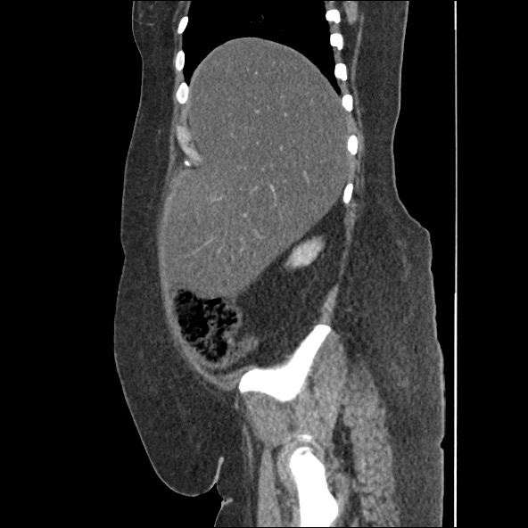 Bowel and splenic infarcts in acute lymphocytic leukemia (Radiopaedia 61055-68915 C 53).jpg