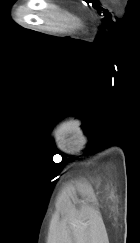 Bowel ischemia (Radiopaedia 58273-65382 C 70).png
