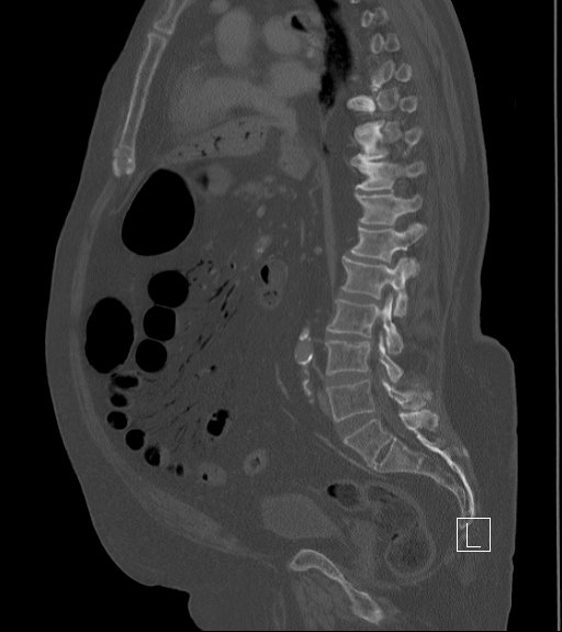 Bowel ischemia secondary to SMA occlusion with extensive portomesenteric venous gas (Radiopaedia 54656-60871 Sagittal bone window 55).jpg