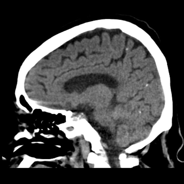 Brain cortical laminar necrosis (Radiopaedia 25822-25971 non-contrast 23).jpg