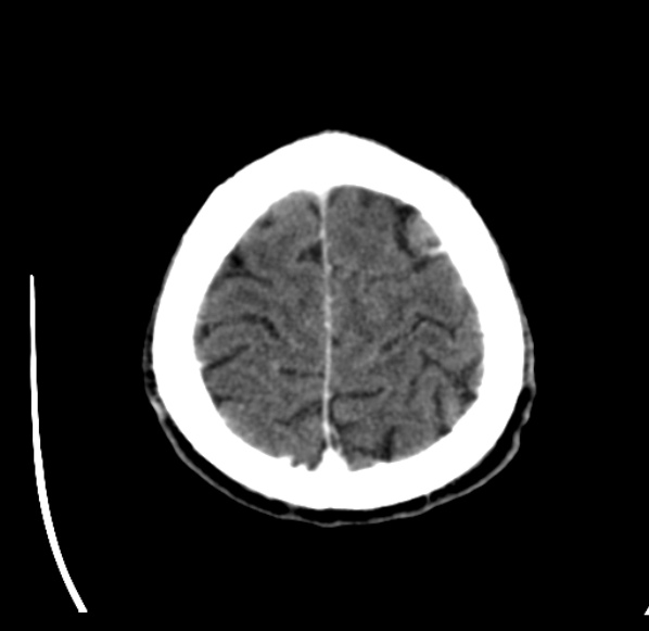 File:Brain metastases from lung cancer (Radiopaedia 24480-24781 Axial C+ delayed 55).jpg