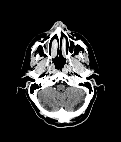 Brain metastasis (large cystic mass) (Radiopaedia 47497-52106 Axial C+ 15).png