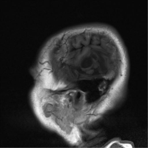 File:Brain metastasis (large cystic mass) (Radiopaedia 47497-52107 Sagittal T1 3).png
