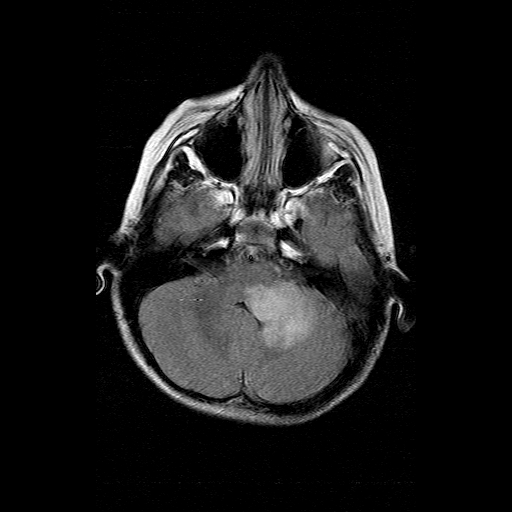 File:Brainstem ganglioglioma (Radiopaedia 10763-11224 Axial FLAIR 15).jpg