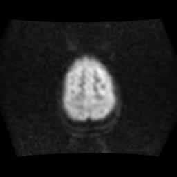 File:Brainstem glioma (Radiopaedia 30923-31624 Axial DWI 16).jpg