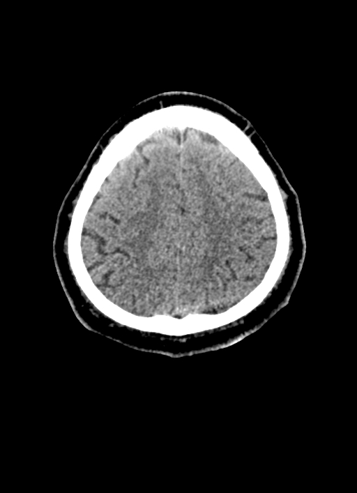 Brainstem hemorrhage (Radiopaedia 81294-94976 Axial non-contrast 16).jpg