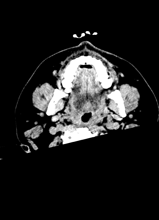 Brainstem hemorrhage (Radiopaedia 81294-94976 Axial non-contrast 75).jpg