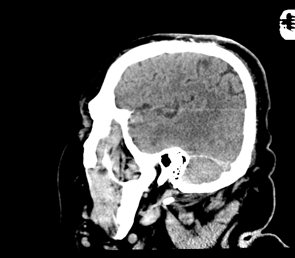 Brainstem hemorrhage (Radiopaedia 81294-94976 C 47).jpg