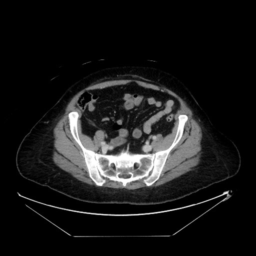 File:Breast cancer pseudocirrhosis with lobar invovlement (Radiopaedia 81080-94670 A 120).jpg