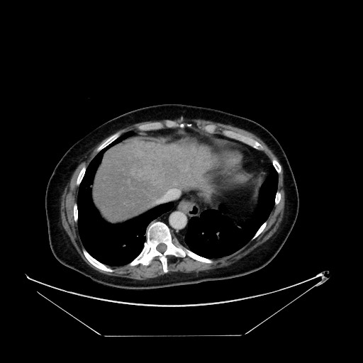File:Breast cancer pseudocirrhosis with lobar invovlement (Radiopaedia 81080-94670 Axial 139).jpg