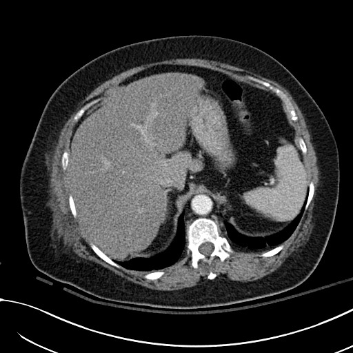 Breast carcinoma with pathological hip fracture (Radiopaedia 60314-67974 A 49).jpg