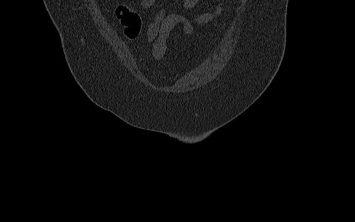 Breast carcinoma with pathological hip fracture (Radiopaedia 60314-67993 Coronal bone window 29).jpg